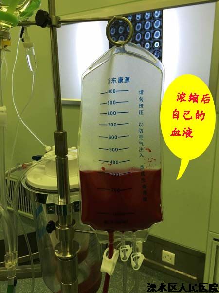 自体血回输  将流失的1000毫升血“抢”回来