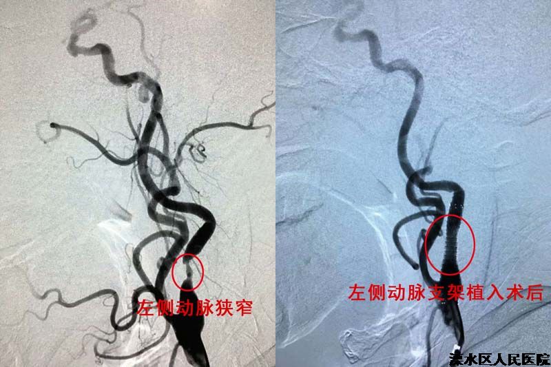 ​神经内科“一台两术”再创神话