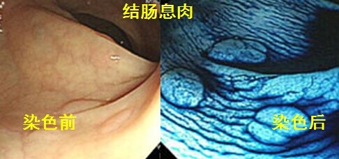 我院消化科染色内镜技术顺利通过专家组验收